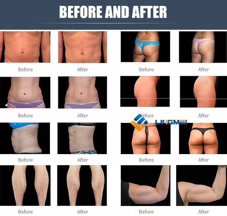 before and after for emslim neo emslim  nova 