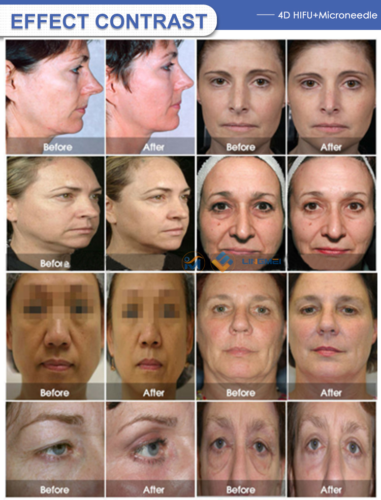 fracional rf microneedle hifu machine before and after