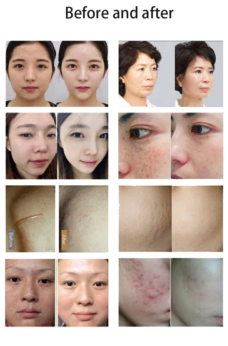this is morpheus 8 fractional rf machine before and after treatment effect for skin care